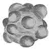 Round kidney stone
