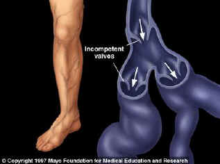 Illustration of bad valves causing varicose veins.